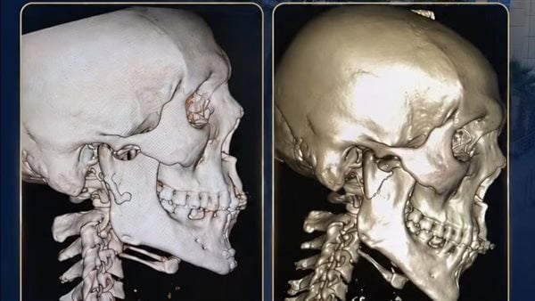 استغرقت 4 ساعات.. نجاح عملية معقدة في جراحة الوجه والفكين داخل مستشفى الكرنك بالأقصر