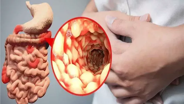 اكتشاف جديد يفسر سببًا خفيًا لالتهاب الأمعاء لدى بعض المرضى