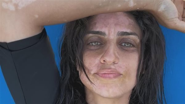 نسرين كرارة تتحدث عن تجربتها مع البهاق: “بقالي 3 سنين”