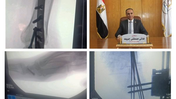 نجاح 5 عمليات جراحية في قسم العظام بمستشفى الفشن المركزي