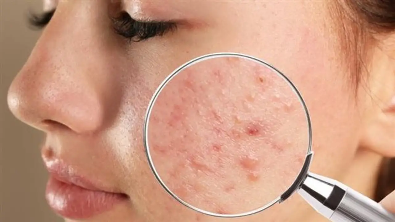 تجنبي هذه العادات: 8 أسباب شائعة تؤدي لظهور حب الشباب