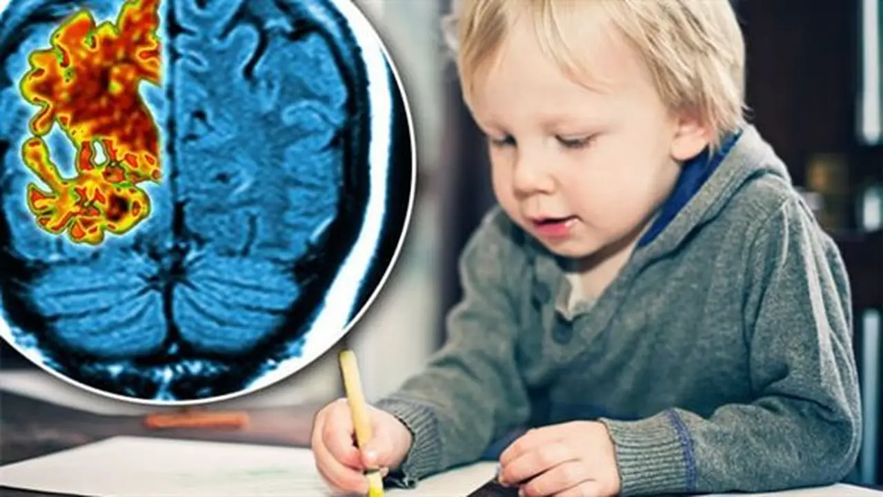 دراسة تربط بين مرض وراثي نادر لدى الأطفال وألزهايمر