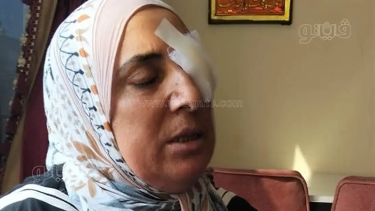سيدة بالإسماعيلية تفقد عينها بعد تعرضها للضرب على يد أقاربها بسبب نزاع على الميراث