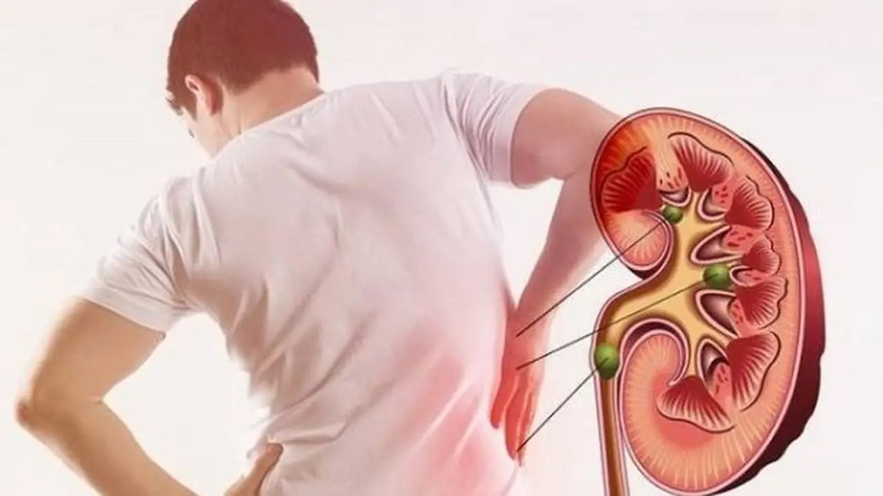 أخطاء يومية تؤثر على صحة الكلى وتزيد من خطر تكوّن الحصوات